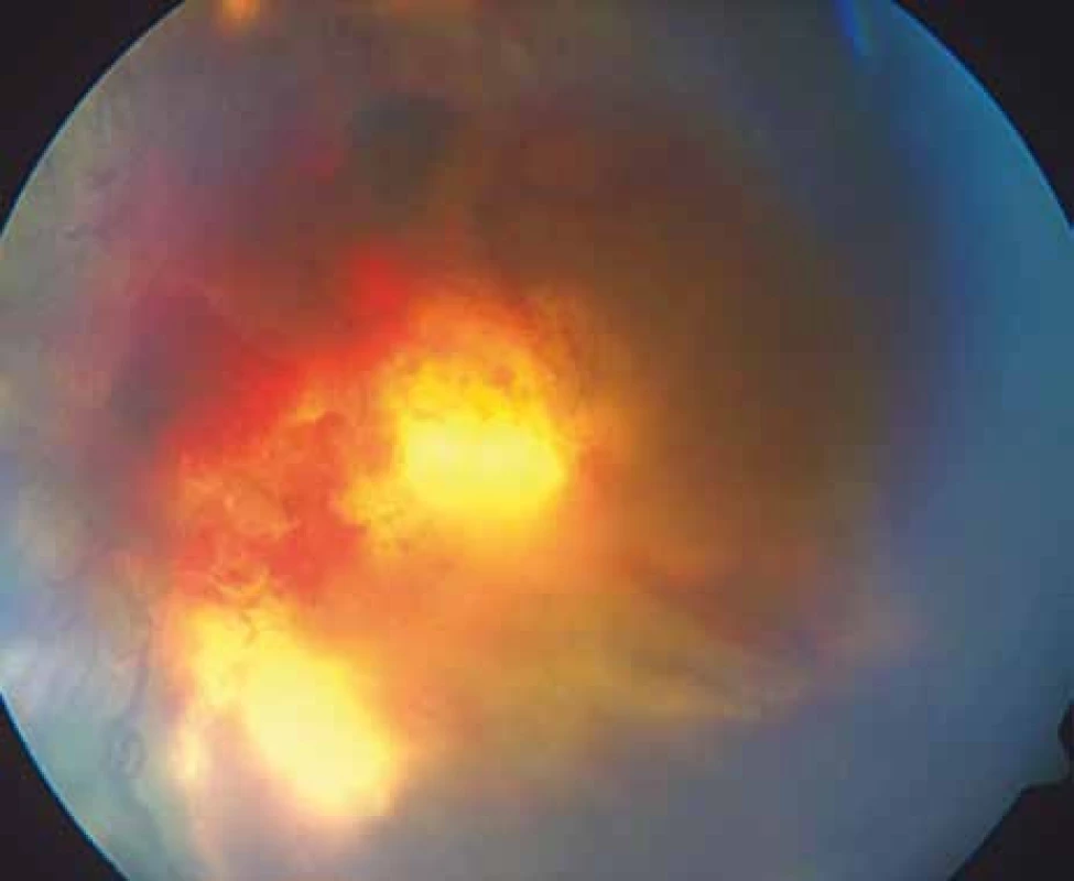 Pacientka č. 1: Fundus oka levého: proliferativní diabetická retinopatie, nelze diferencovat ani papilu zrakového nervu ani makulu pro rozsáhlé fibrovaskulární změny a krvácení překrývající struktury sítnice v oblasti zadního pólu oka.