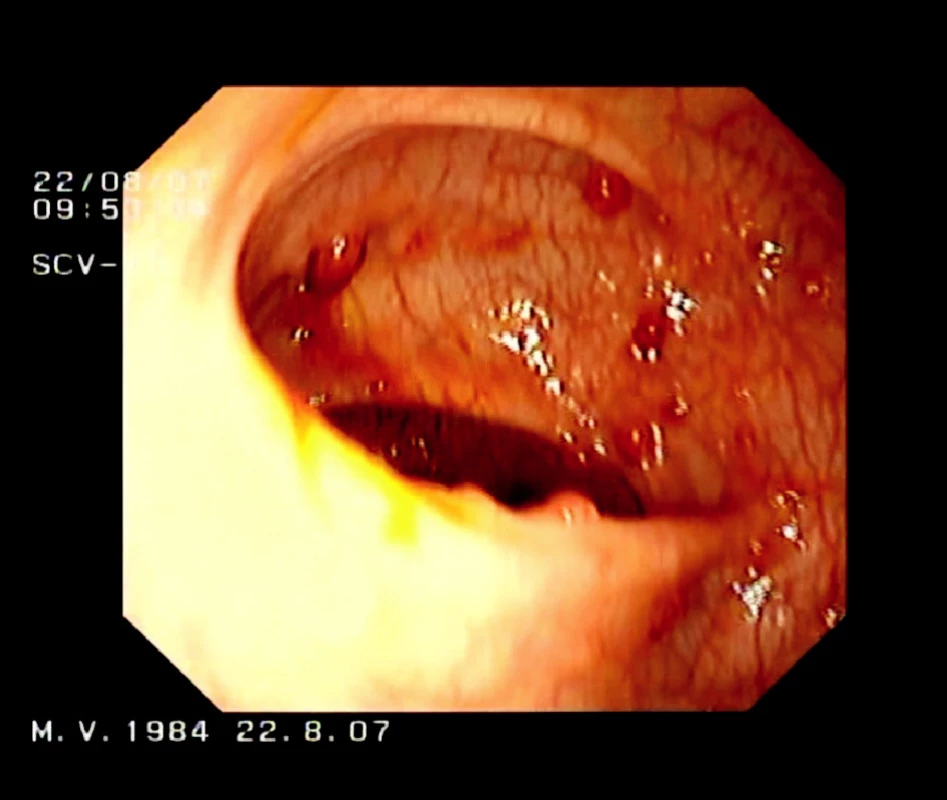 Kolonoskopický nález u pacienta s FAP
Fig. 1. Patient with FAP – colonoscopic finding 