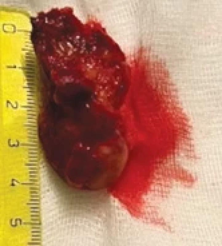 The tumor after extraction.