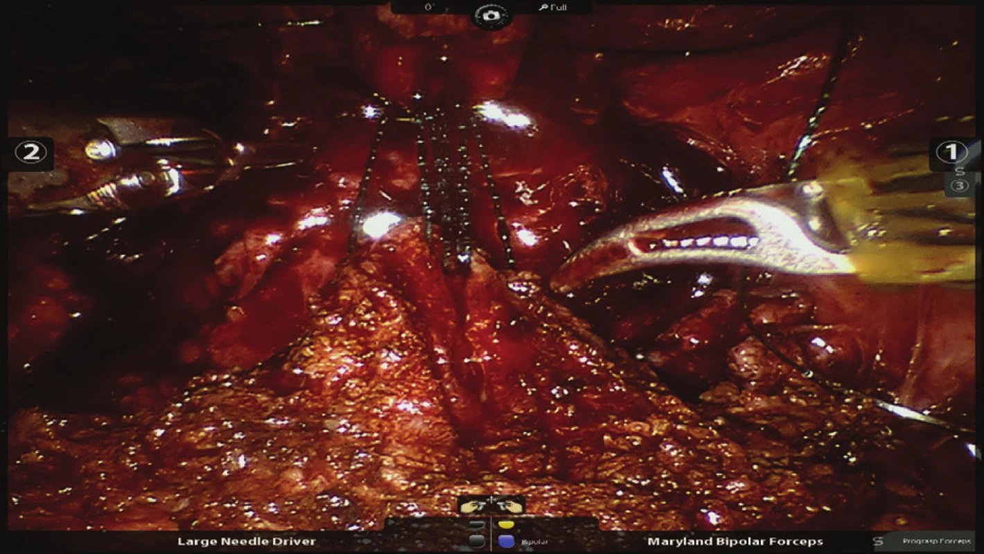Nasazení prvních stehů při šití veziko-uretrální anastomózy
Fig. 7: Placing the first sutures on the vesicourethral anastomosis