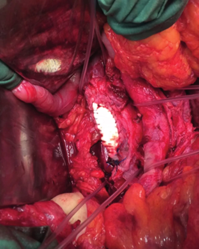 Plastika VCI pomocí ePTFE záplaty
Fig. 3: IVC reconstruction using an ePTFE patch