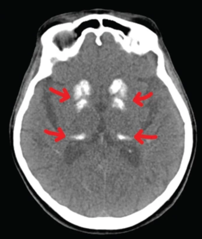 CT snímka pacientky s viditeľnými symetrickými kalcifi kátmi (červené šípky). </br>Fig. 1. The patient’s CT scan with visible symmetric calcifi cations (red arrows).