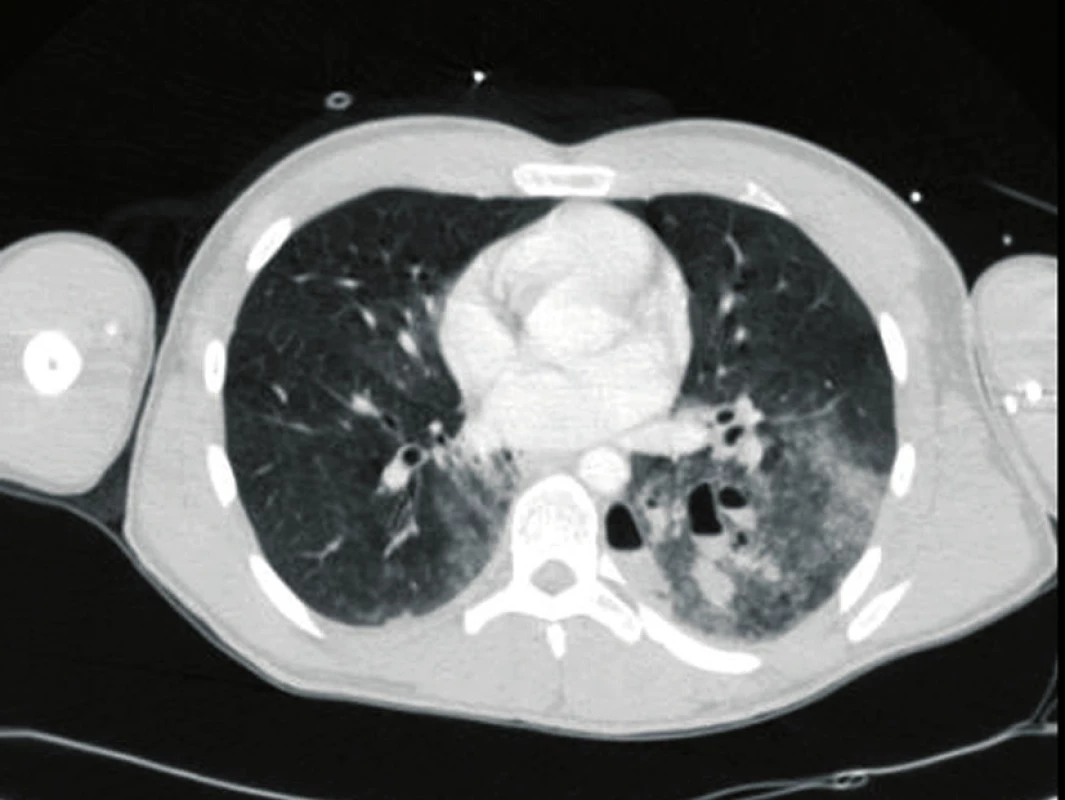 Axial CT