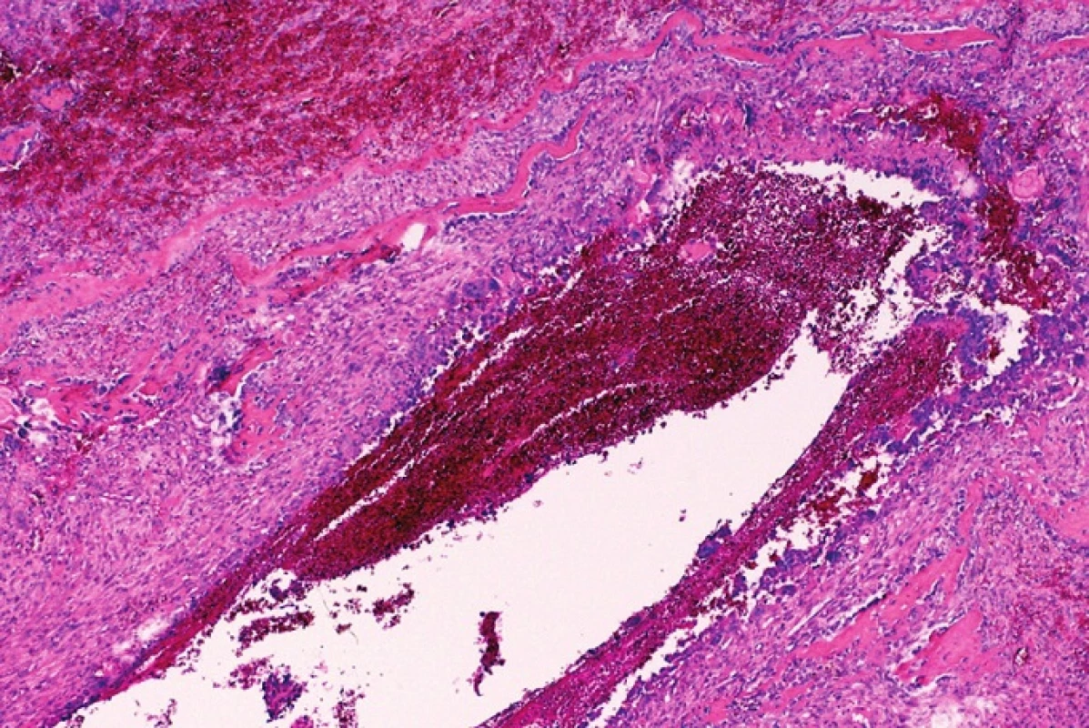 Reaktivní osteoplazie ve formě trámečků pletivové kosti je běžnou součástí vazivových sept aneuryzmatické kostní cysty. HE, x100.