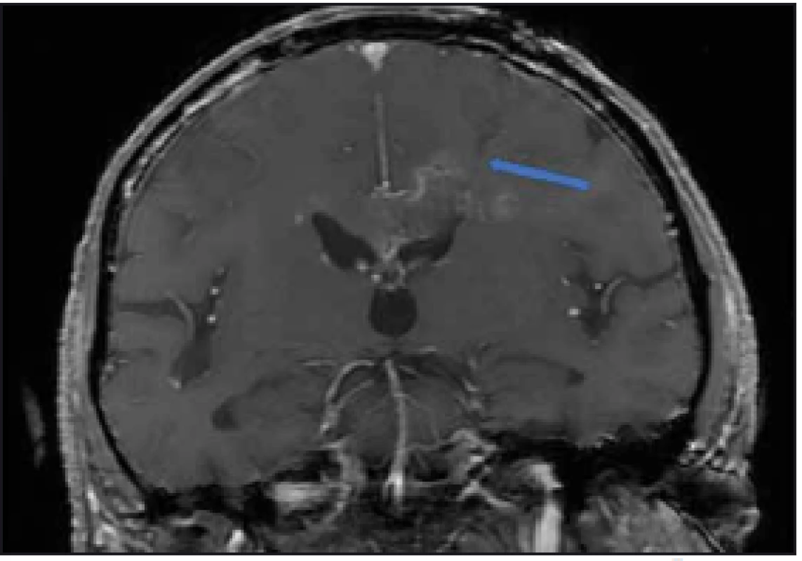 Peroperační MR kontrola, T1 vážení s kontrastem. Šipkou označen bioptický kanál končící v ložisku. Bez krvácivé komplikace.
Fig. 2. Intraoperative MRI, T1 image with contrast. Channel after biopsy runs into the lesion (arrow). No postoperative bleeding.