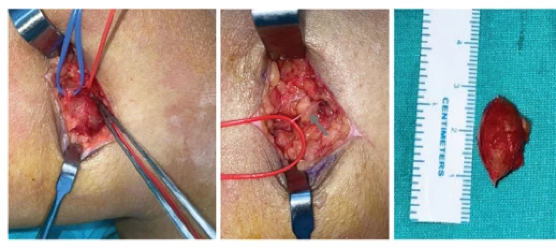 Schwannoma arising from the right saphenous nerve at thigh level, which was excised preserving the nerve fascicle.
