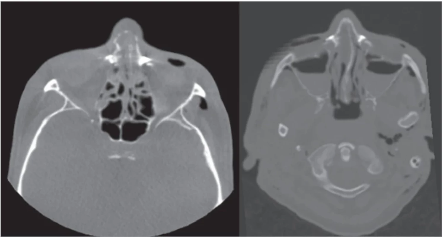 Intraoperative cone beam computed tomography of nasal bones (left); nasal bones on the postoperative multislice spiral computed tomography – neurosurgical indication (right).