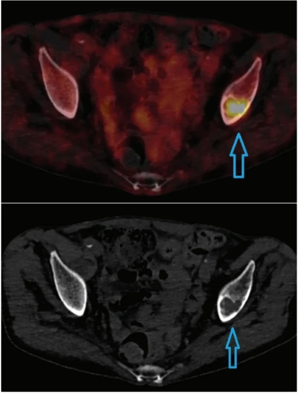 Hypermetabolická lytická léze nad levým acetabulem s náznakem sklerotizace v trámčině v okraji léze.