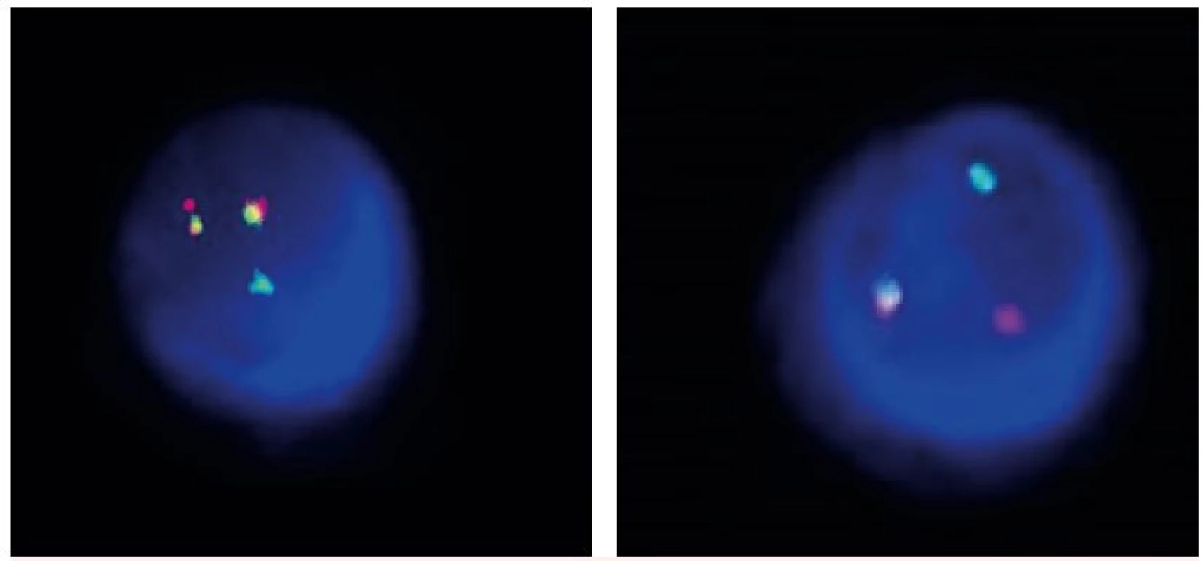 Translokace t(4;14)
A – standardní nález (2F1R1G), B – variantní nález (1F1R1G)