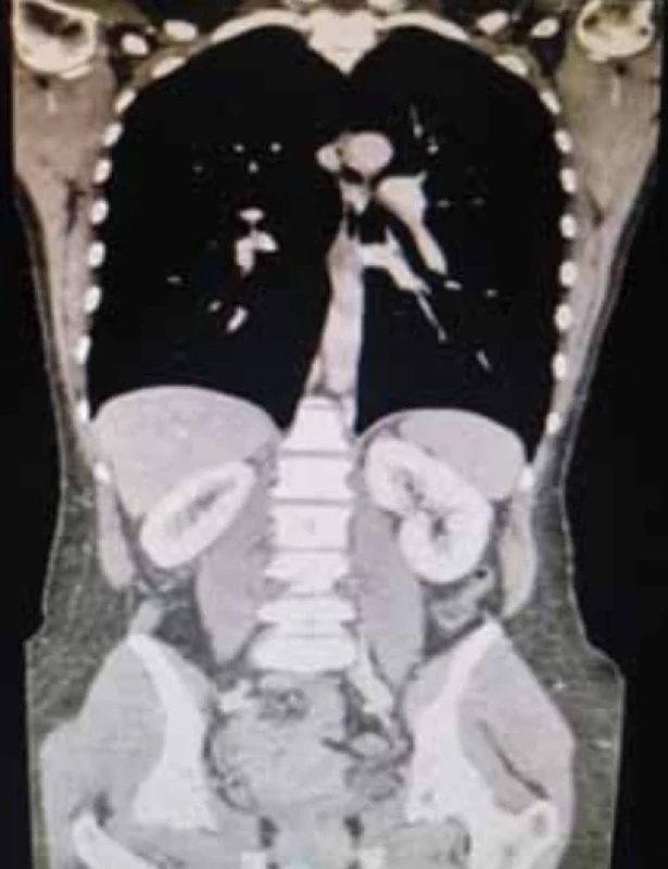 Computed tomography in coronal section of thoraco-abdominal venous reconstruction after administration of iodinated contrast medium in the venous phase, for staging of the disease and related lymph nodes. // Výpočetní tomografie ve svislém řezu thorakoabdominální žilní rekonstrukce po podání jodové kontrastní látky v žilní fázi pro staging onemocnění a přilehlých lymfatických uzlin.