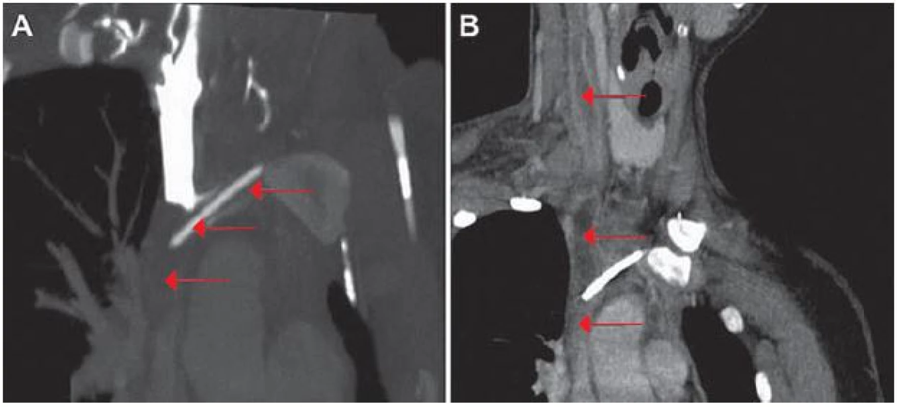 Výpočetní tomografie angiografie, koronární projekce.