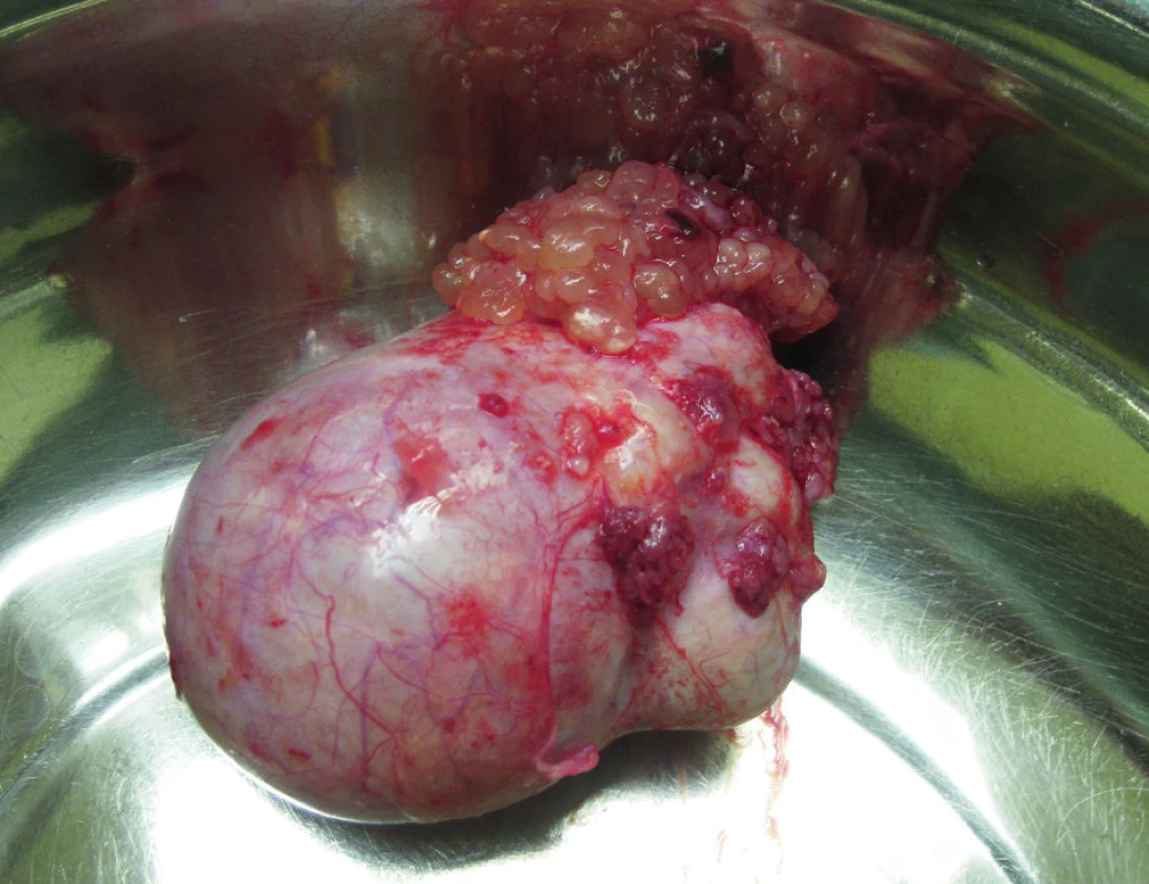 Seromucinózní borderline tumor