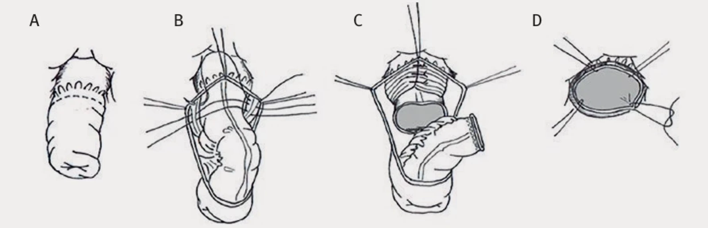  Altemaierova operace – překresleno z [38]. Altemaire procedure – withdrawn from [38].