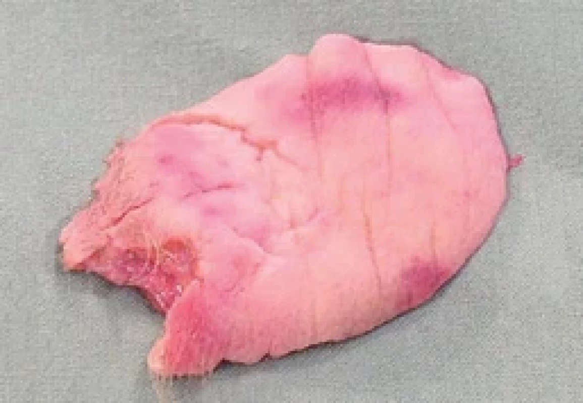 Forehead avulsion fl ap. Source: archive of authors.