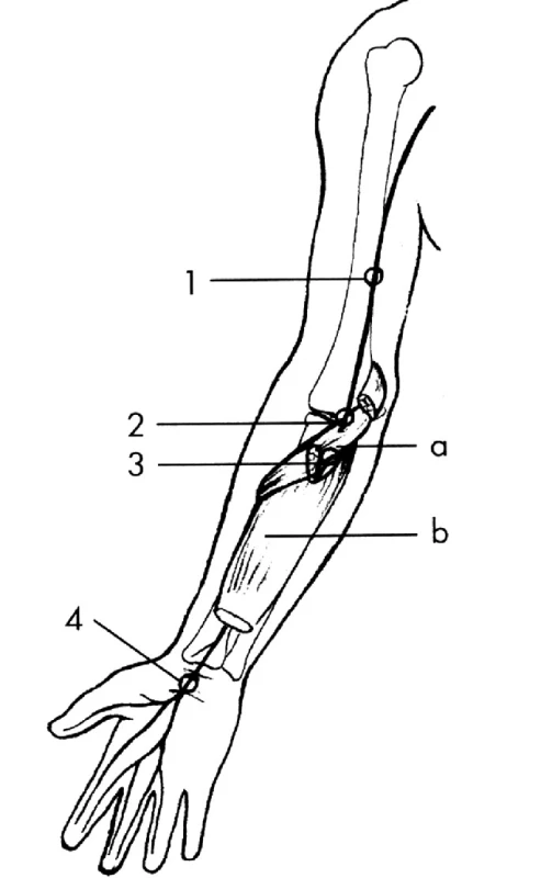 medianus – úžinové syndromy
Úžiny:
1 – StruthersÛv kanál,
2 – pronátorový kanál,
3 – n. interosseus anterior,
4 – karpální tunel.
Svaly:
a – hluboká hlava m. pronator teres,
b – m. flexor digitorum superficialis.