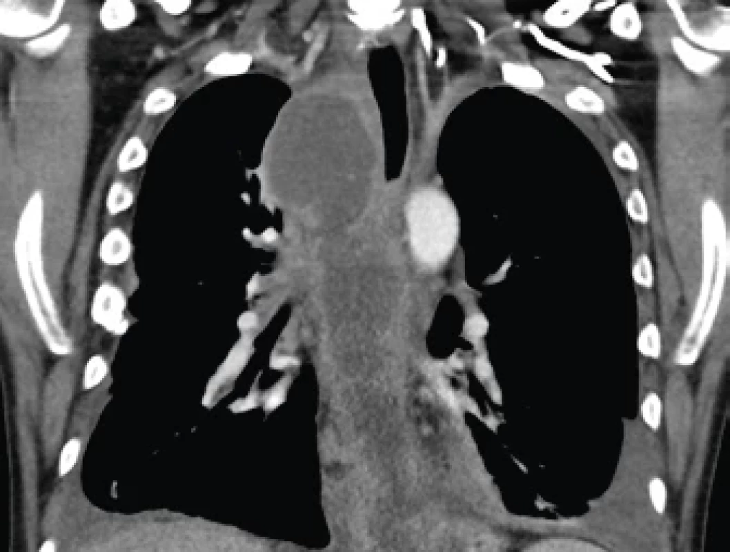 CT snímek hrudníku – pseudocysta mediastina před drenáží – koronární rekonstrukce.