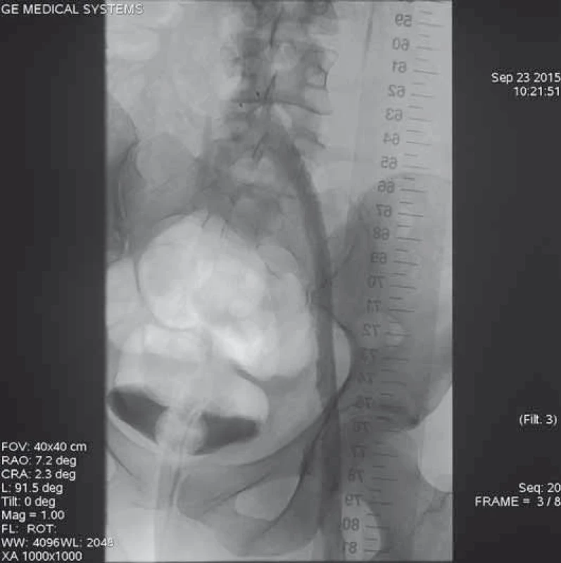 Výsledná angiografie ileofemorální trombózy po ukončení lokální trombolitické terapie a zavedení tří stentů do levostranných ilických žil.