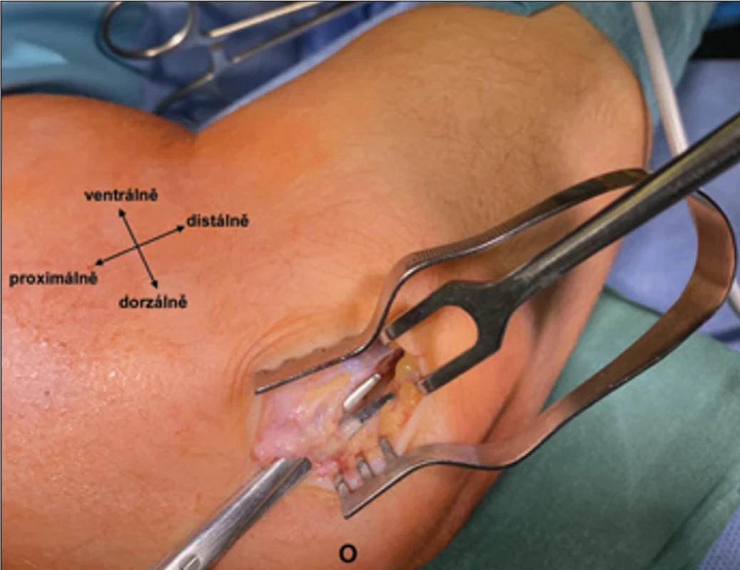 Intraoperační pohled na Osbornův vaz, nůžky jsou vloženy pod Osbornův vaz.  Fig. 6. Intraoperative view of Osborne‘s ligament, with scissors inserted underneath.
