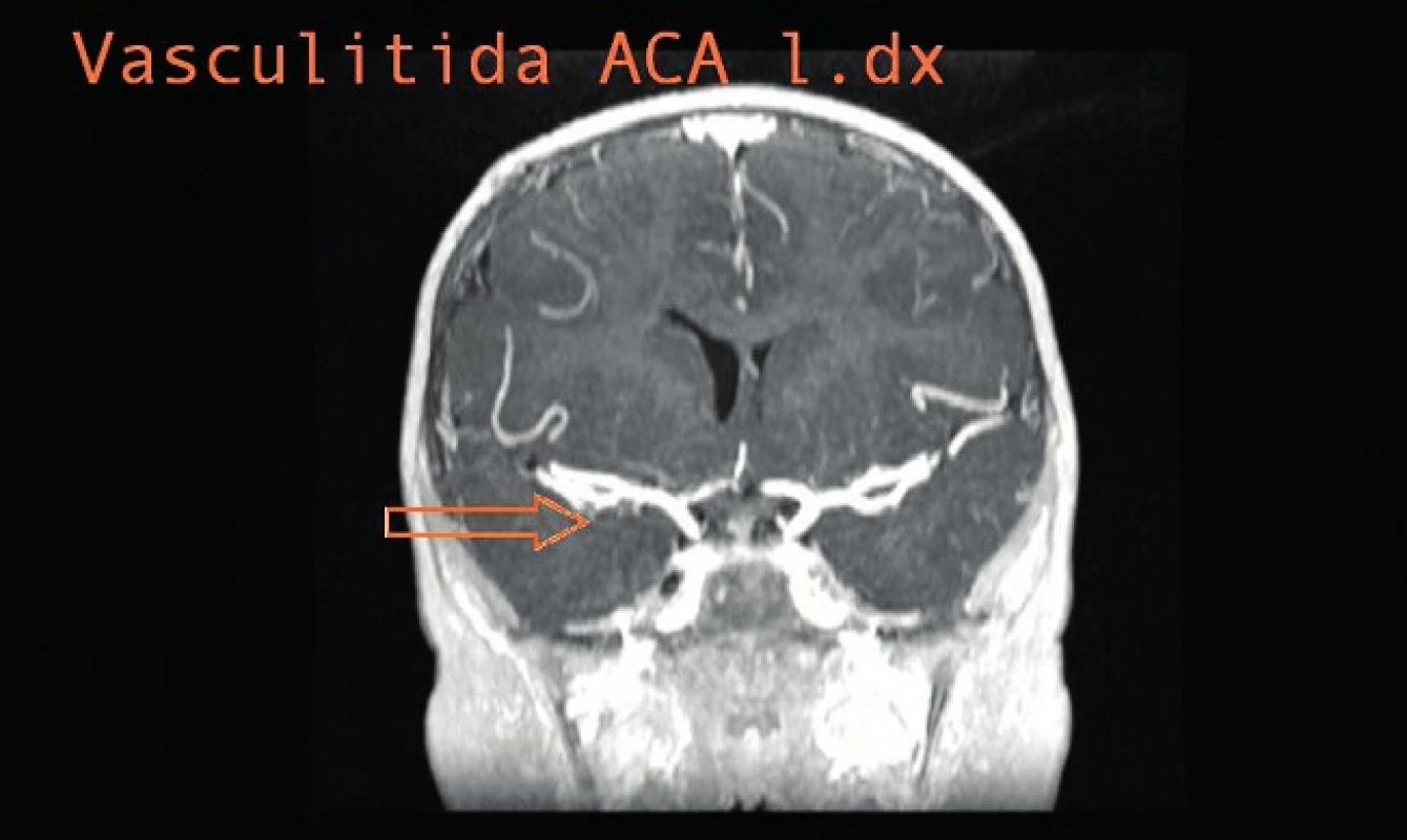Vaskulitida ACA l. dx.
Fig. 7. Vasculitis of ACA l. dx.