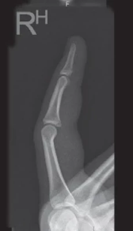 A stable proximal interphalangeal joint volar plate injury suitable for non-operative treatment.
