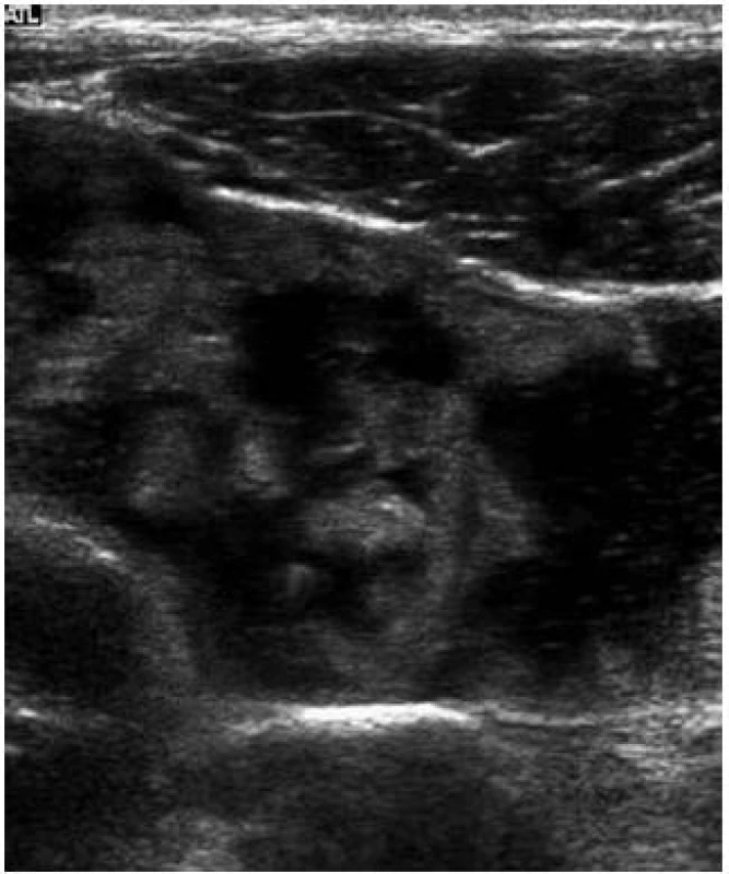 Celiakální sprue – zmnožení řas na ileu – „jejunizace ilea“.
Fig. 6. Celiac sprue – plethora of villi on the ileum – „jejunization of the ileum”.