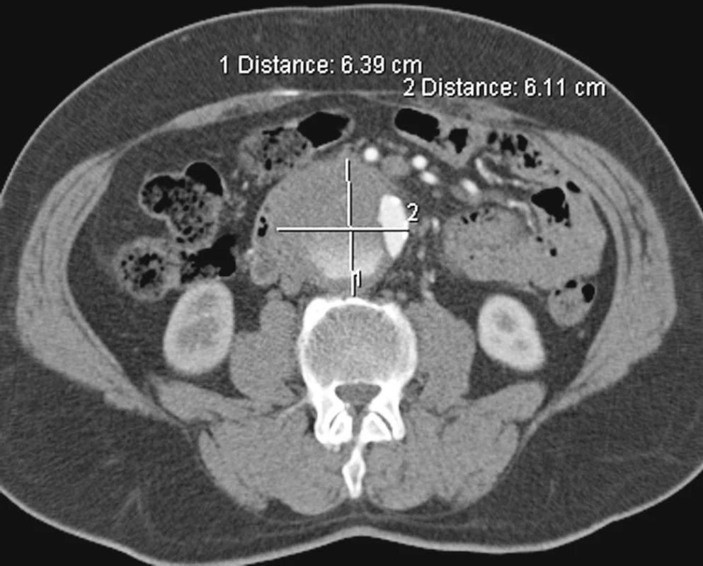 Kontrolní CTA po 3 měsících s rostoucí aneuryzmatickou dilatací nepravého lumen subrenálně
Pic. 16. A control CTA view 3 months later depicting growing subrenal aneurysmatic dilation of the false lumen