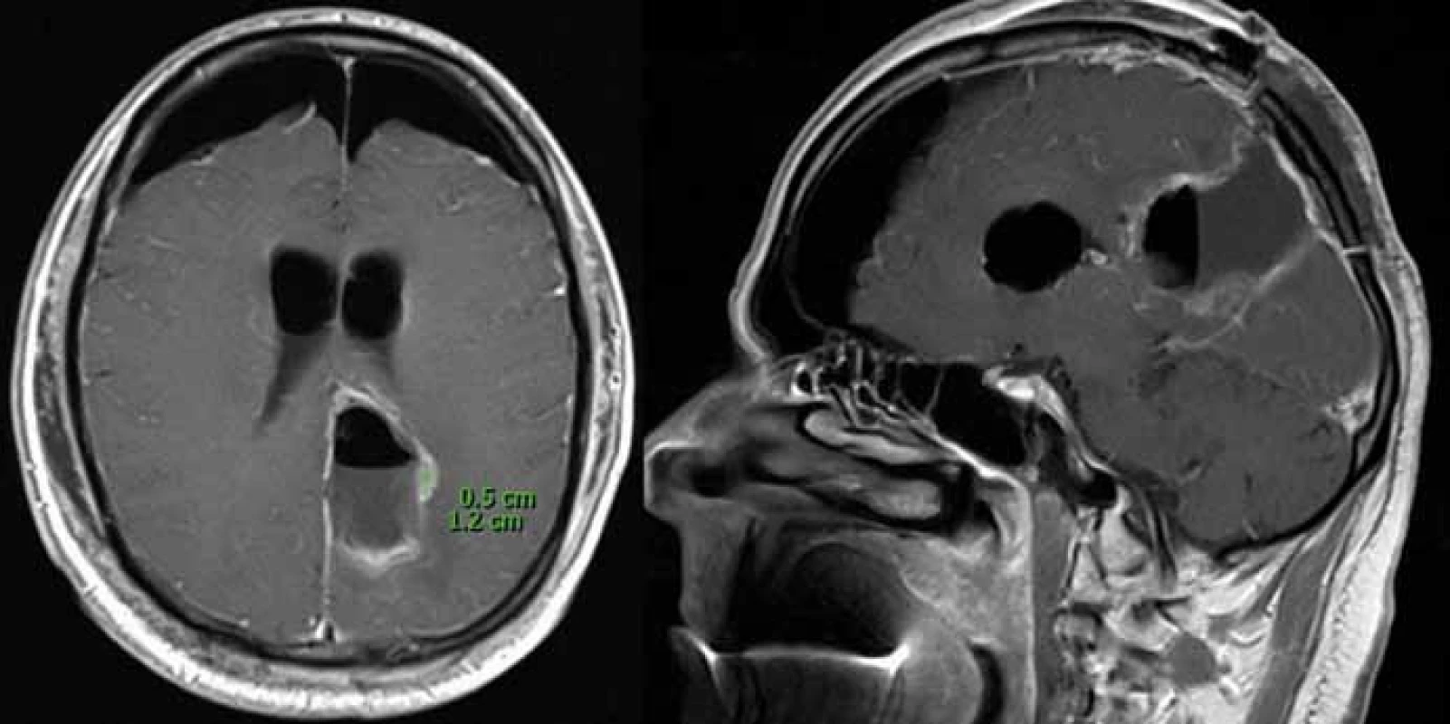 Časná pooperační MR (1. pooperační den) ukazující postresekční dutinu a reziduální tumor o velikosti 0,5 × 1,2 cm na axiálním (A) a sagitálním (B) skenu naléhající
na pyramidovou dráhu.
Fig. 3. Early postoperative MR scan (1st day) showing postresection cavity and residual tumour 0,5 × 1,2 cm on axial (A) and sagittal (B) plane, tight on pyramidal tract.