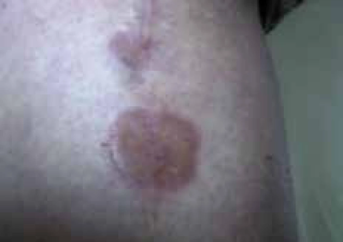 Necrobiosis lipoidica, lokalizovaná forma