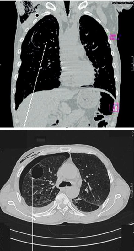 CT izolované plicní buly a parciální PNO
Fig. 1. A CT scan of an isolated pulmonary bule and partial pneumothorax
