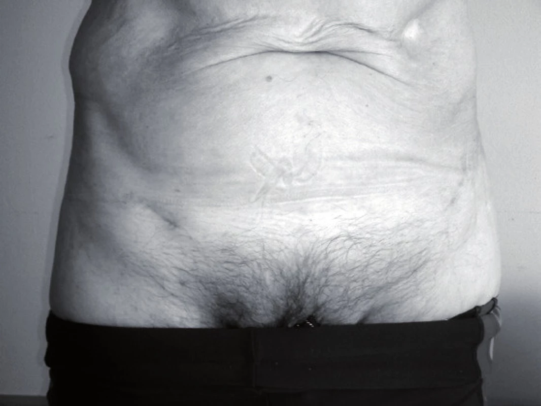 Fotografie 6 týdnů od operace – patrné pouze drobné incize, bez prominence osteosyntetického materiálu
