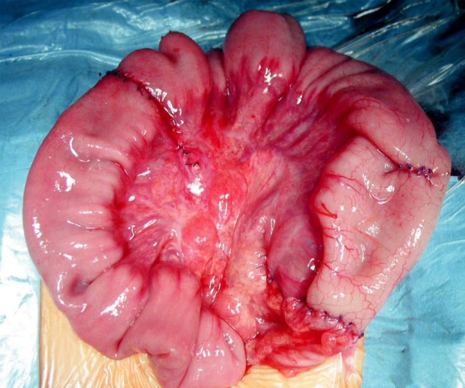 Operačný výkon: sutura po punkčnej enterotómii, ileo-ascendento anastomóza, ileo-ileo anastomóza
Fig. 5. Surgical procedure: a suture following punction enterotomy, anastomosis between the ileum and the ascendent colon, ileo-ileal anastomosis