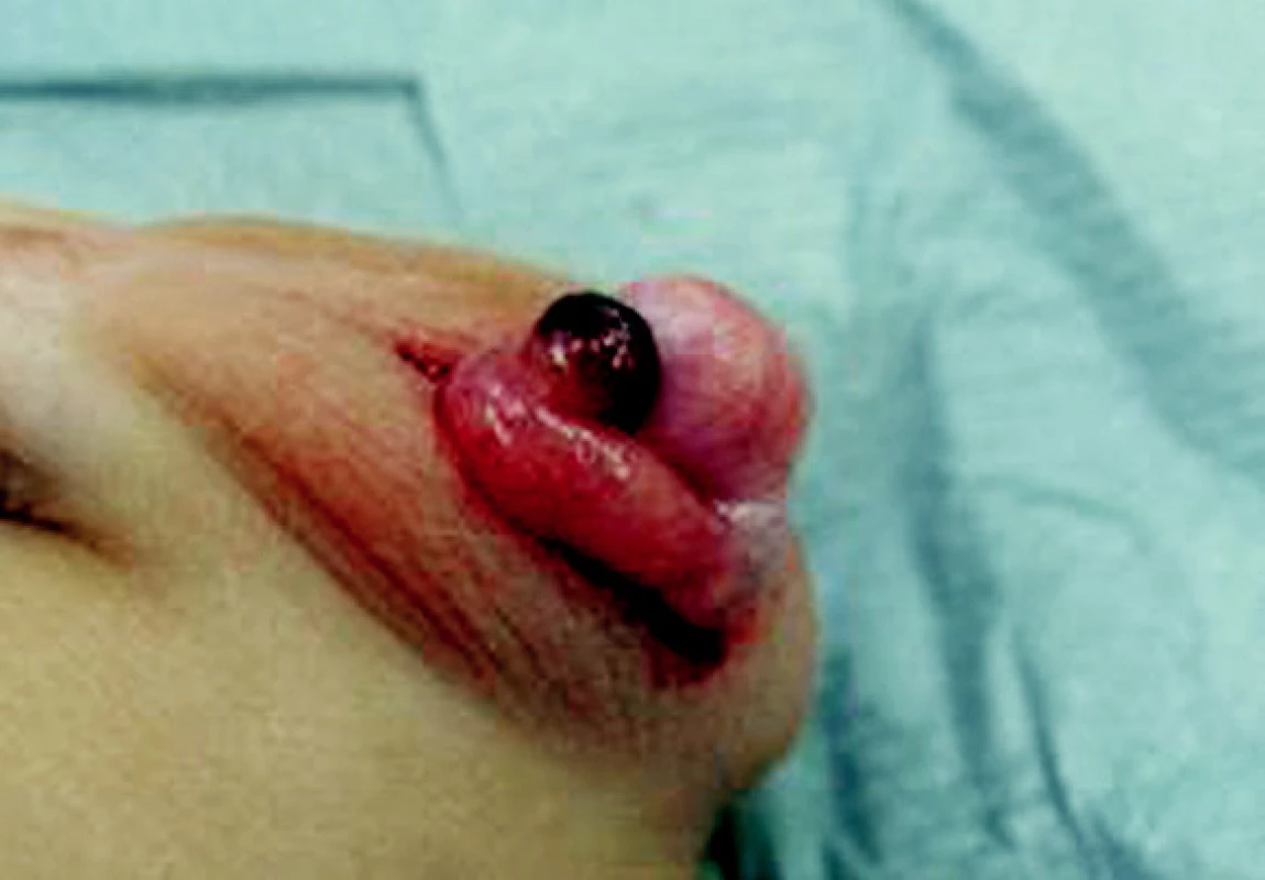 Torzia appendixu testis
Fig. 1. Torsion of testicular appendix
