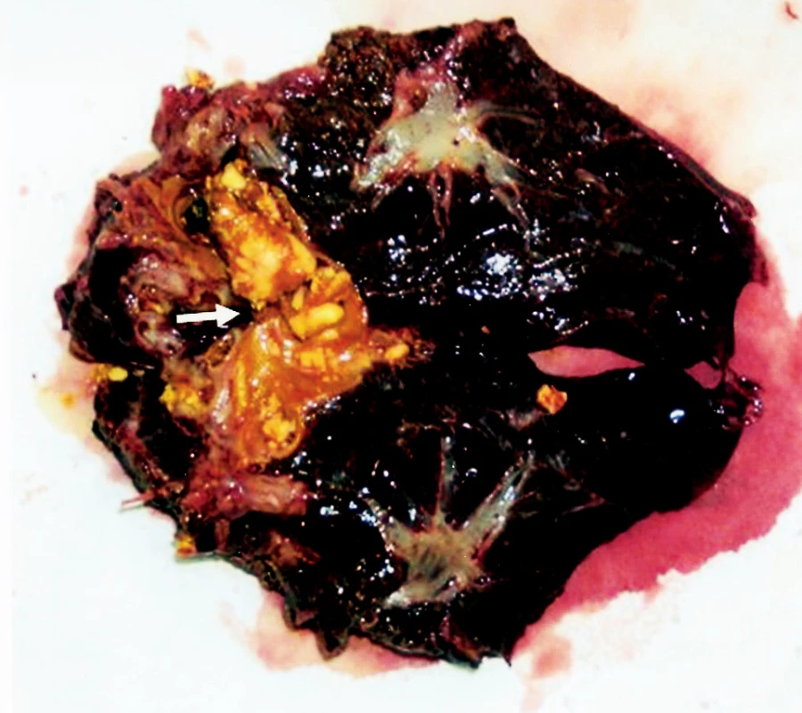 Resekát SII a SIII segmentu jater
Fig. 5. A resecate of the SII and SIII liver segment
Šipka ukazuje mnohočetné odlitkové konkrementy v dilatovaných a sklerotických žlučovodech resekovaných segmentů 
An arrow indicates multiple cast concrements in dilated and sclerotic bile ducts of the resected segments