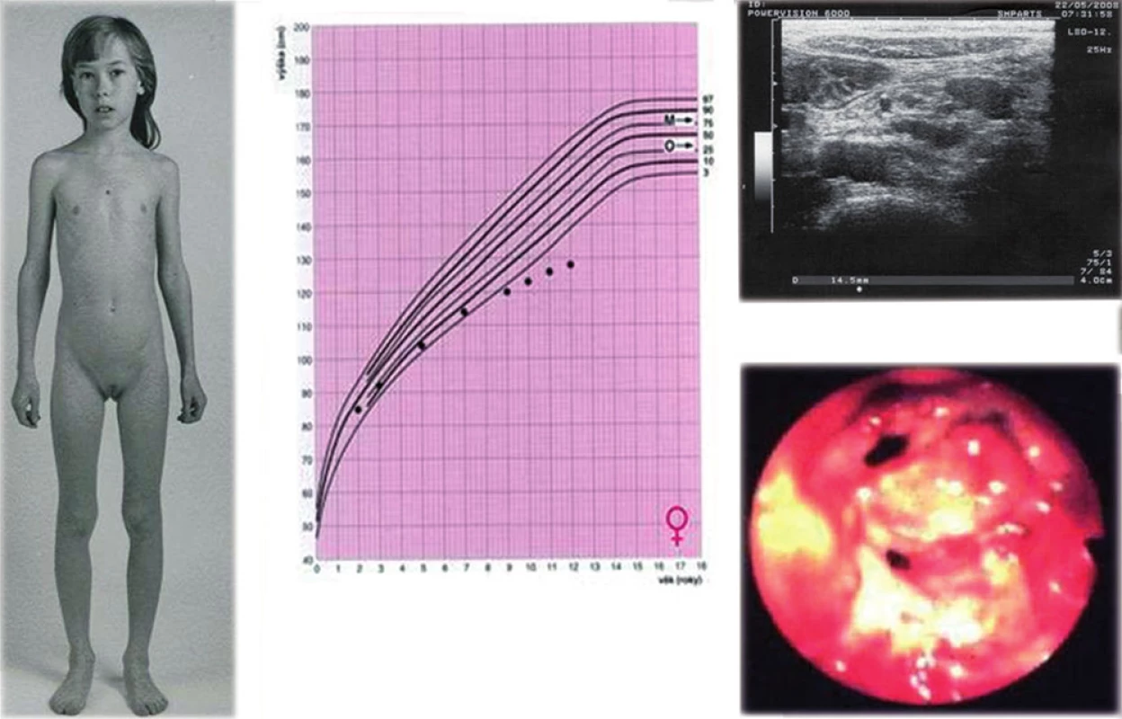 a, b, c, d. Dívka s progresivní růstovou retardací, u které byla následně zjištěna Crohnova nemoc (a, b). Sonografie ukázala zvětšené mezenteriální lymfatické uzliny a lehce rozšířenou stěnu terminálního ilea (c), kolonoskopie verifikovala těžké zánětlivé změny (d – pohled do oblasti Bauhinské chlopně).