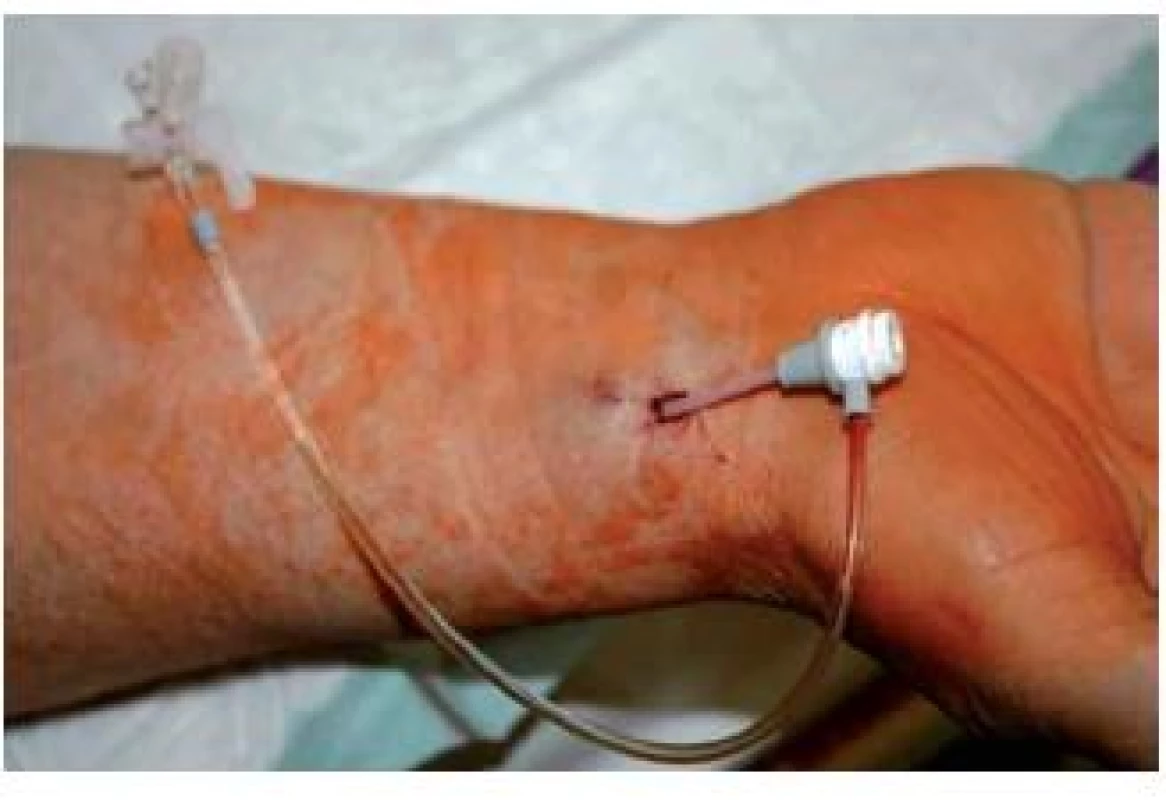 Transradiální přístup: pouzdro 5F je zavedeno do radiální tepny