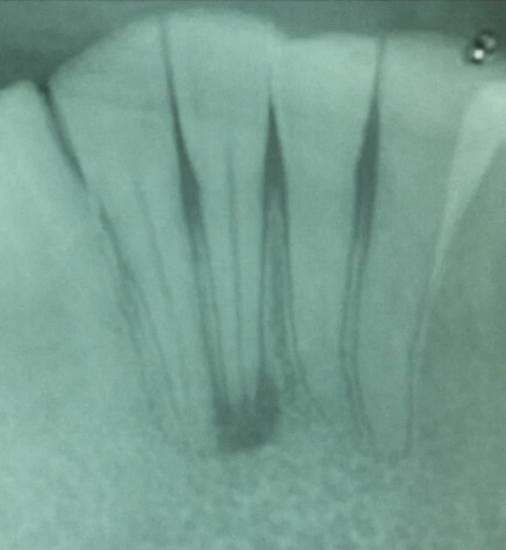 Externá zápalová resorpcia koreňa s výskytom periapikálneho granulómu intaktného zuba 41 – šesť rokov po traume. Zdroj: Simona Fritzká. Fig. 5 External inflammatory root resorption with periapical granuloma findings in an intact tooth 41 – six years after trauma. Source: Simona Fritzká.