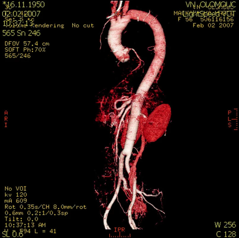 CT rekonstrukce pooperačního stavu hrudní a břišní aorty po náhradě cévní protézou
Fig. 4. A CT reconstruction of the postoperative condition of the thoracic and abdominal aorta following the vascular prosthesis implantation