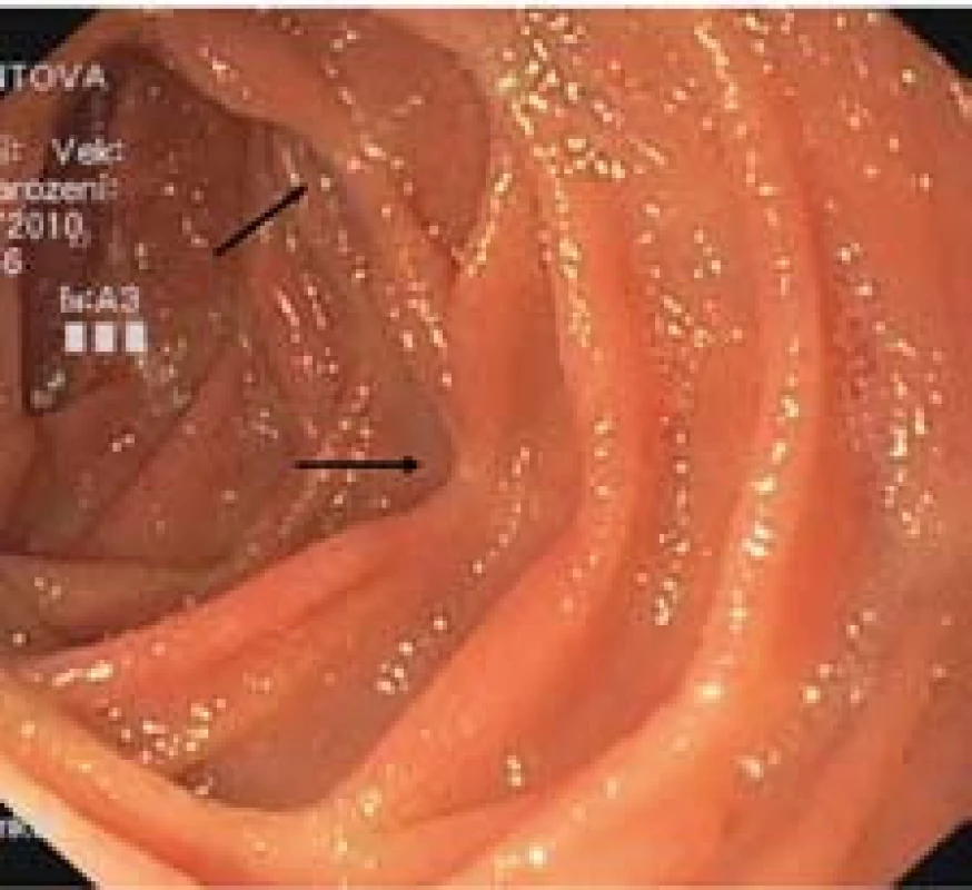 Pozánětlivé změny a deformity řas (šipky).
Fig. 2. Post-inflammatory changes and deformations of intestinal folds (arrows).