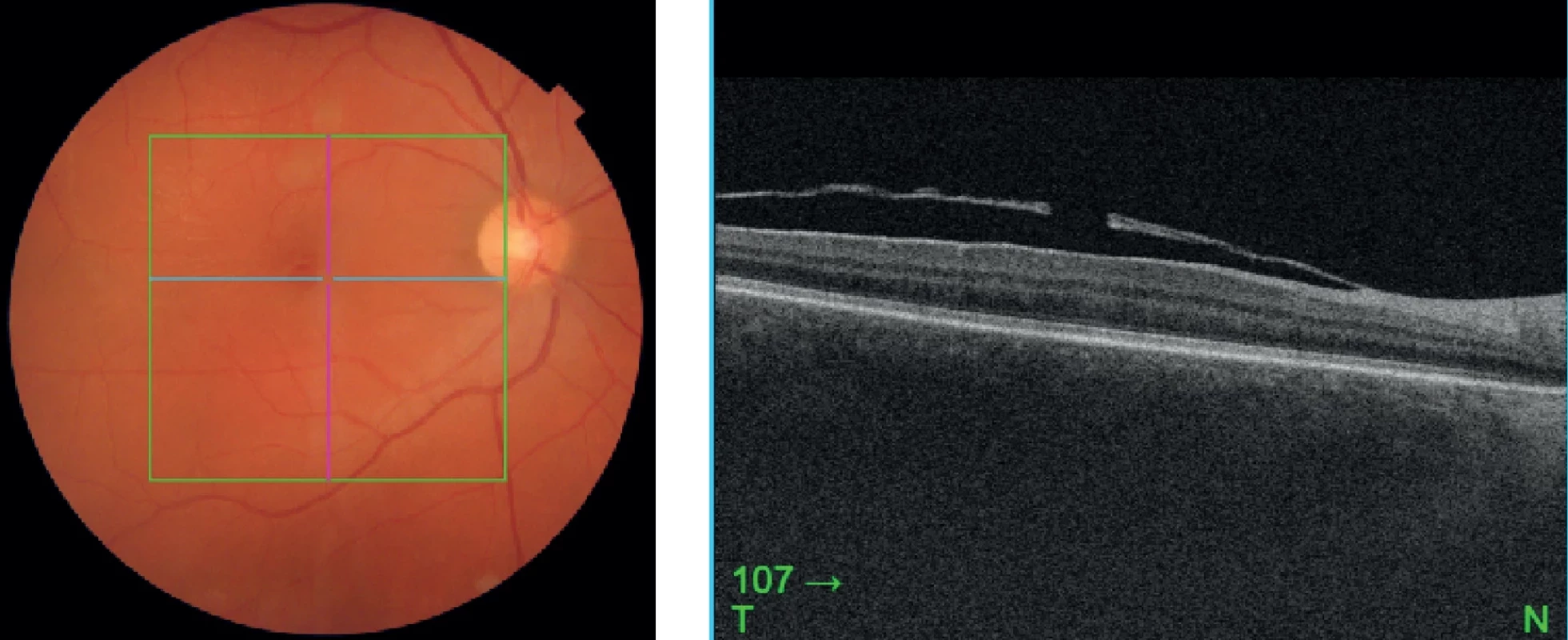 Optical coherence tomography (OCT) and photo of the posterior segment showing the fenestrum after Nd-YAG hyaloidotomy and absorbed hemorrhage