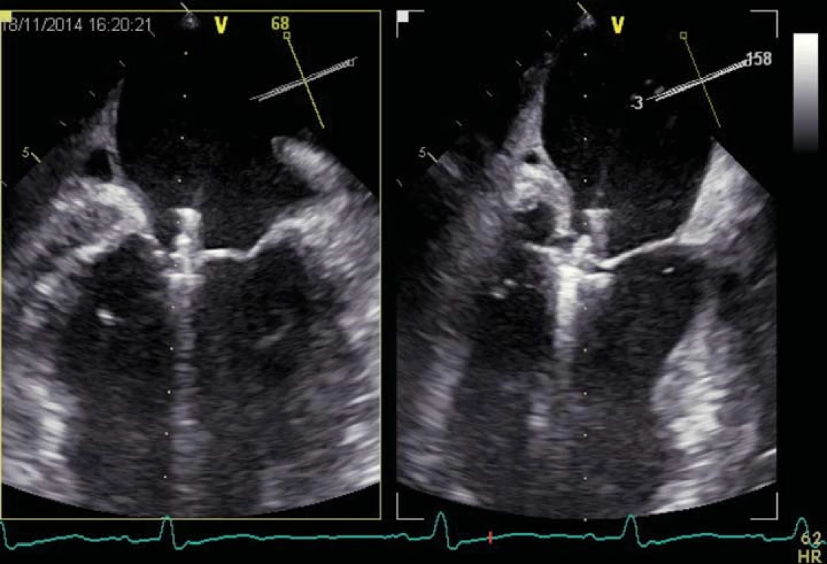 Echokardiografické vyšetření při implantaci MitraClipu.