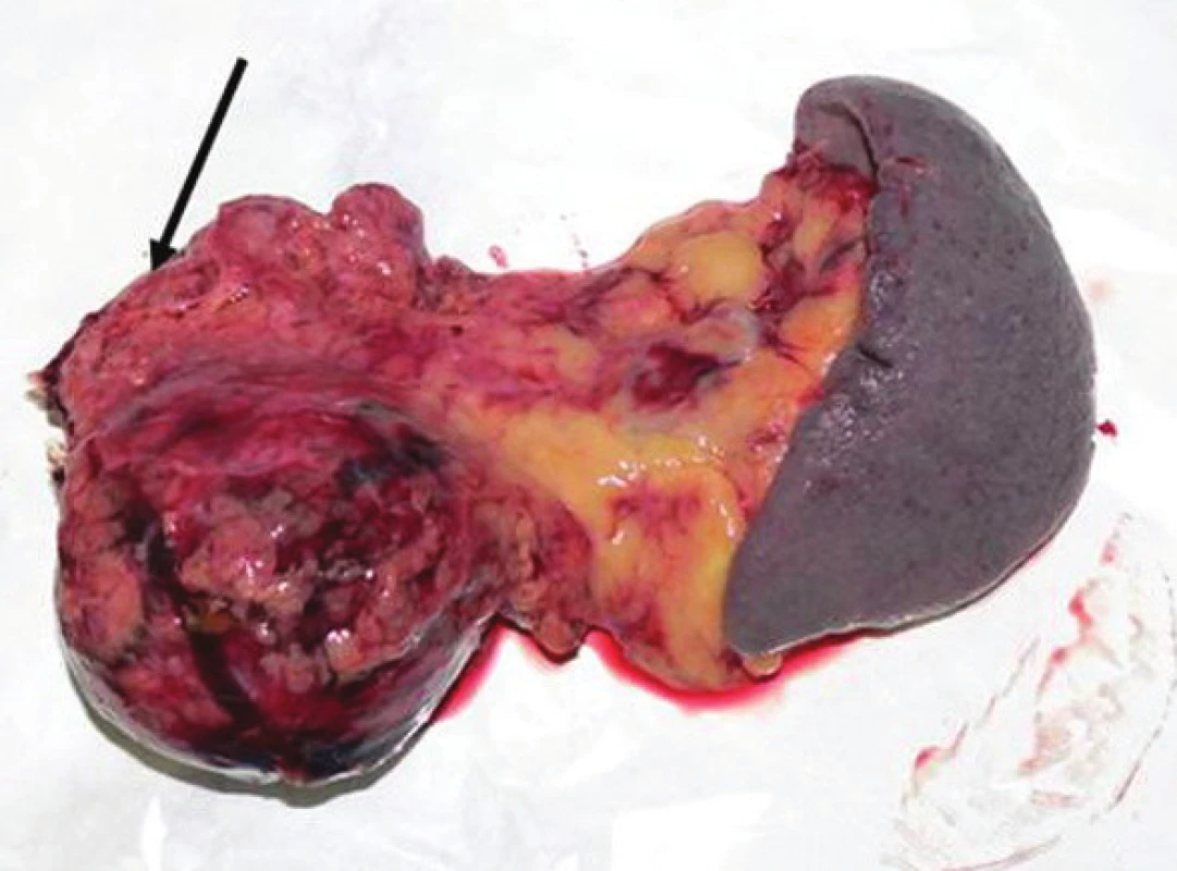 Resekovaný distálny pankreas so slezinou, resekčná línia označená šípkou
Fig. 8. The resected distal pancreas and spleen, the resection line marked with an arrow