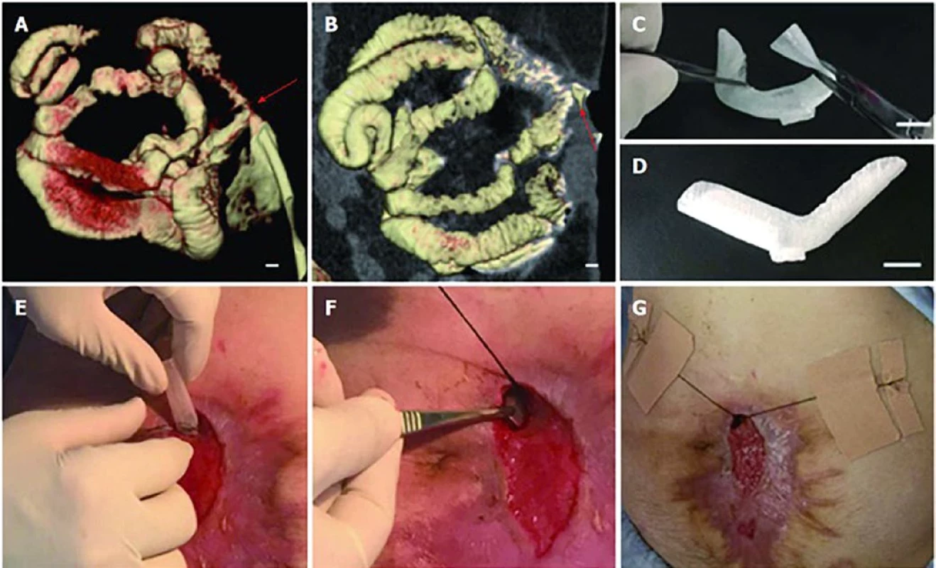 3D Fistula stent – z parametrů píštěle získaných z CT rekonstrukce je vytvořena na 3D tiskárně forma z termoplastického polyesteru. Aplikací silikagelu do formy vzniká stent vytvoření dle parametrů EAF. Převzato z Huang JJ et al. [17].