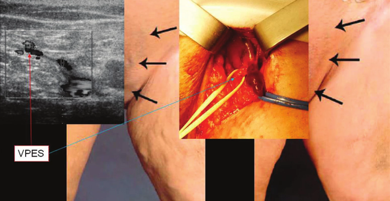 Recidiva varikozit z ponechané VPES
Fig. 3. Relapses of varicosities of the retained VPES