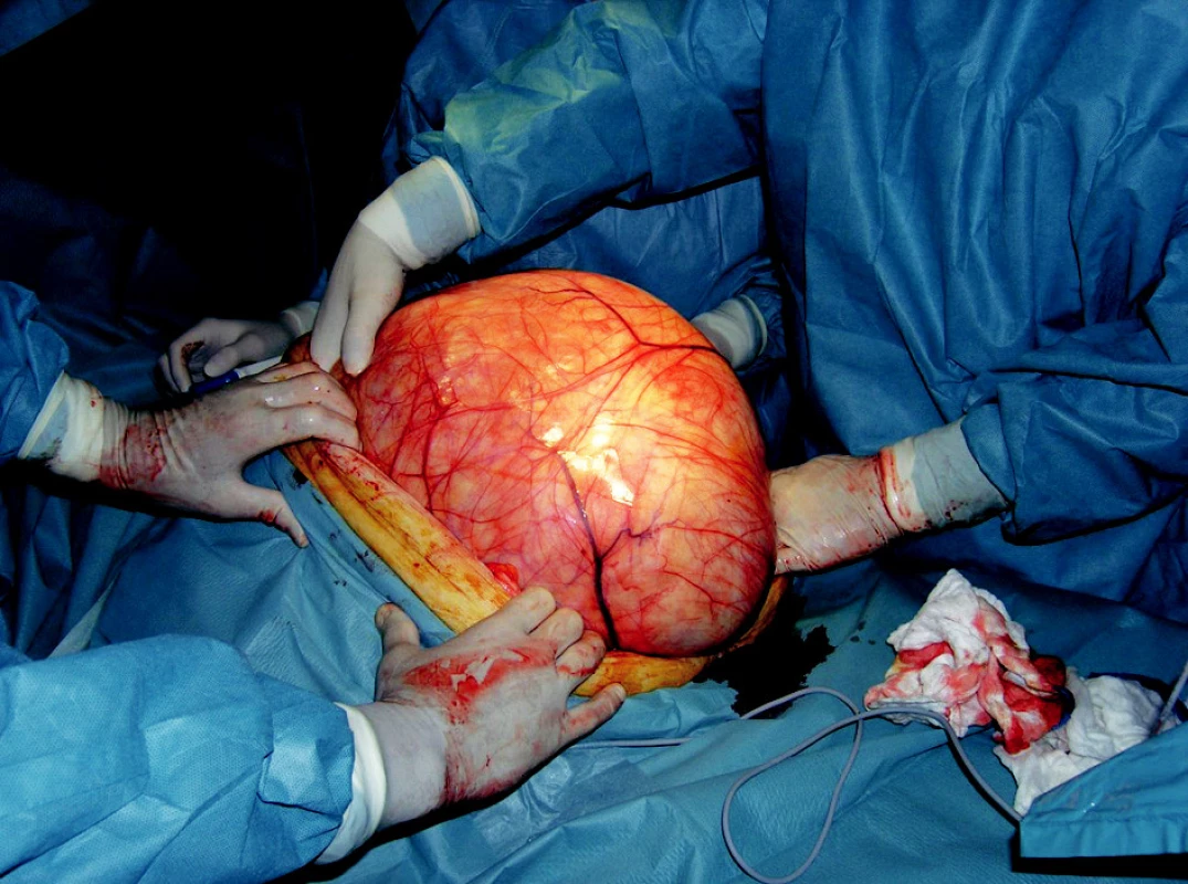  Peroperační nález u pacientky č. 1
Fig. 1. Peroperative finding in the patient No. 1