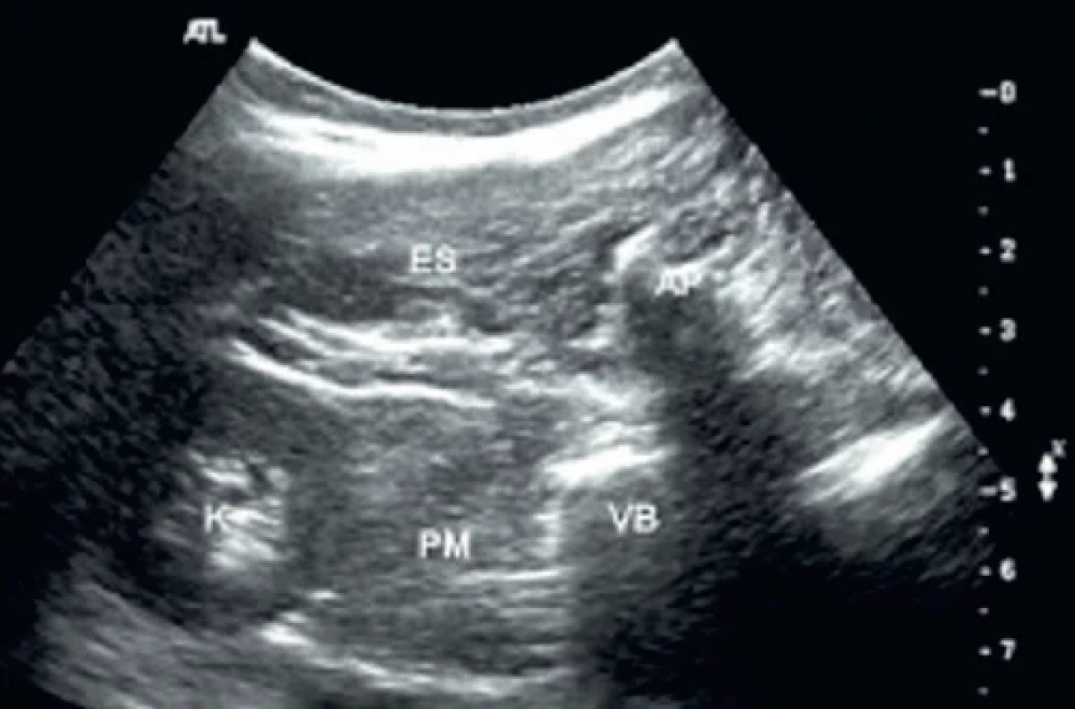 Ultrazvukový obraz pro psoas kompartment blokádu [28,29]. Ultrasound image for psoas compartment block [28,29].