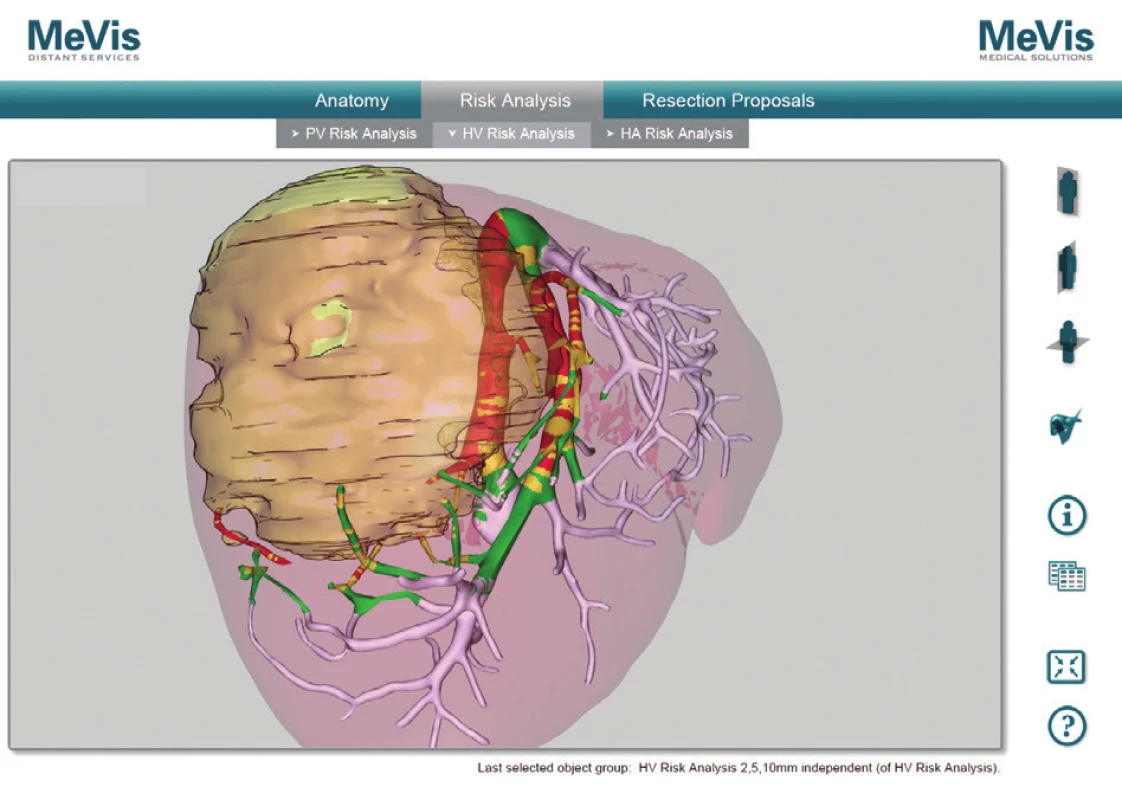 MeVis analýza rizika vzdialenosti hepatálnych žíl od tumoru, pacient č. 3
Fig. 7: MeVis risk analysis of distance between tumor and hepatic veins, patient No. 3
