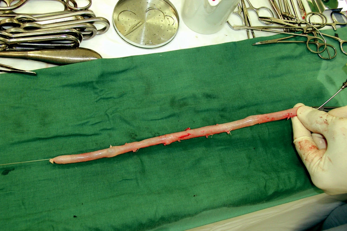 Odebraná hluboká žíla v délce 32 cm a její příprava jako štěp. Všechny větve jsou dvojitě ligovány, chlopně odstraněny. Proximálně má žíla průměr 14 mm, distálně 9 mm. To jsou ideální míry pro aorto/iliako-femorální pozici
Fig. 3. Harvested vein (32 cm long) – procedure for graft preparation. All branches are doubly ligated and valves are disrupted. A diameter of 14 mm proximally and of 9 mm distally are ideal measures for aortoiliofemoral reconstruction