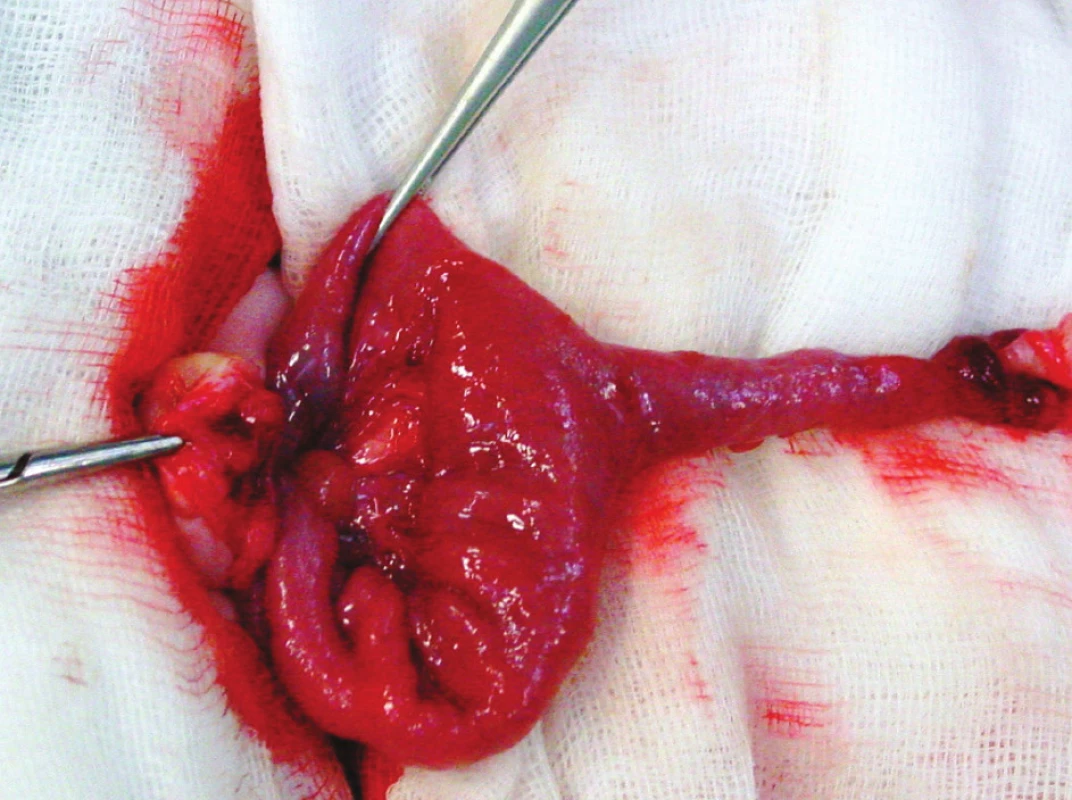 Ductus omphaloentericus persistens před resekcí. Zevní ústí píštěle se střevní sekrecí
Fig. 2. Ductus omphaloentericus persistens prior to its resection. The external orifice of the fistule with intestinal secretion