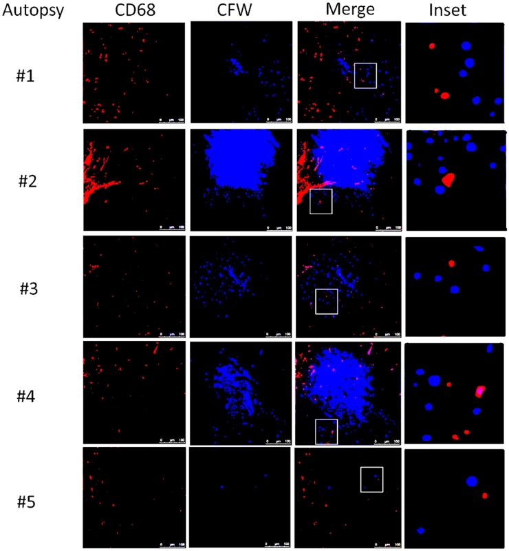 Brain immunofluorescence of autopsy specimens from patients who died of s-CNS cryptococcosis.