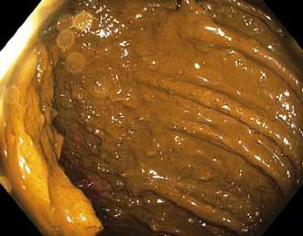 Koloskopie bez střevní přípravy.
Fig. 2. Colonoscopy without bowel preparation.